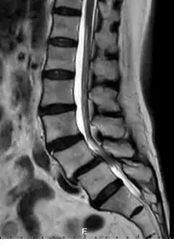 腰椎滑脫合併神經壓迫 MRI 影像，顯示腰椎第四第五節退化與神經壓迫情形