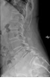 退化性腰椎滑脫術前 X 光側面影像，顯示腰椎第四第五節椎體滑移與不穩定