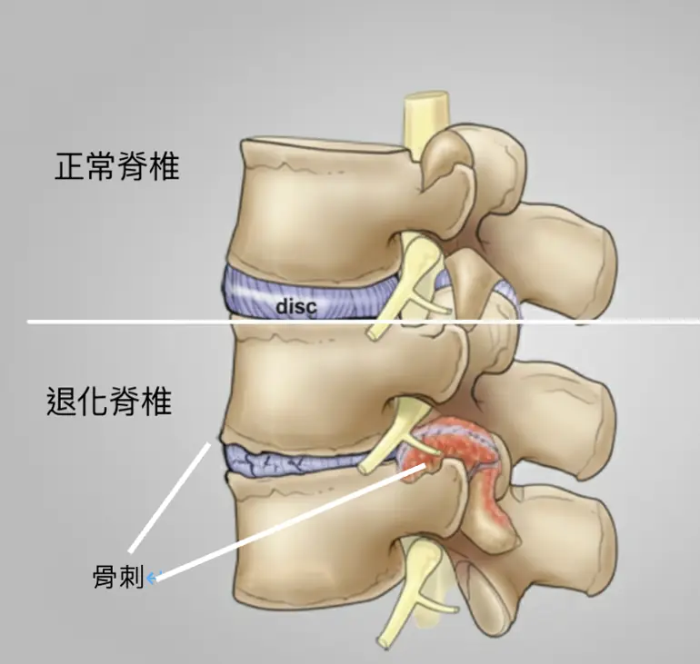 正常脊椎與退化脊椎比較示意圖,說明脊椎骨刺與退化變化
