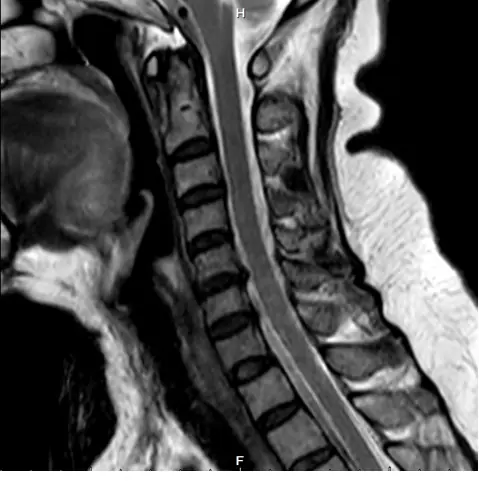 頸椎第五六節椎間盤突出合併神經壓迫 MRI 影像