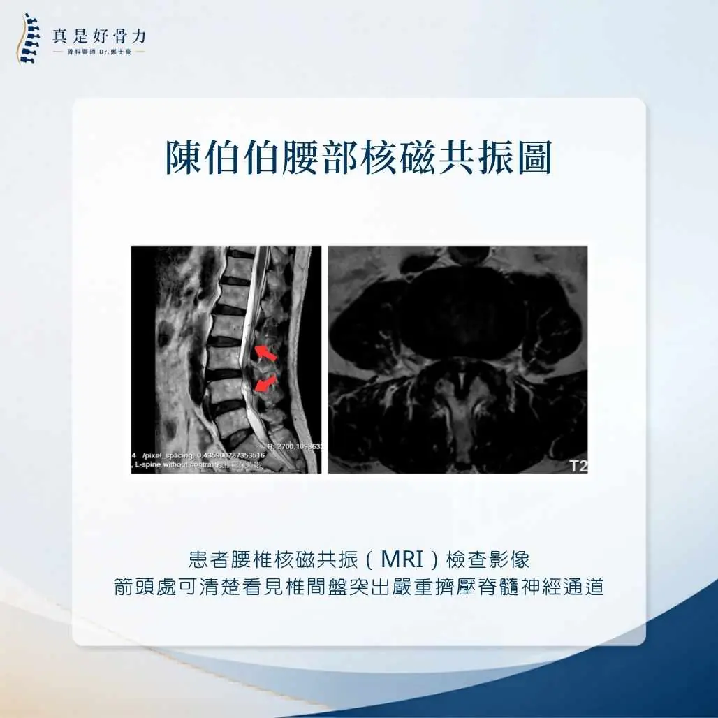 腰椎核磁共振（MRI）影像：清楚顯示椎間盤突出與神經壓迫