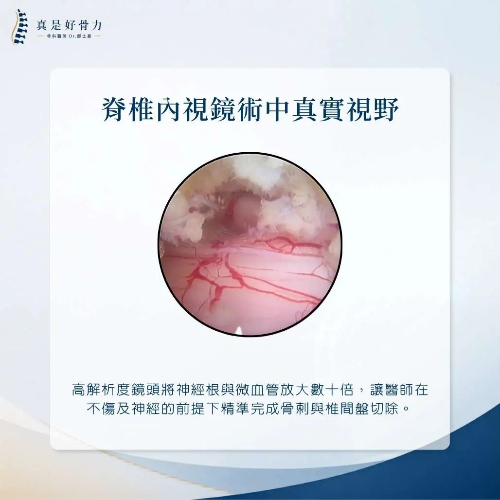 脊椎內視鏡手術術中高解析度視野：清晰呈現神經根與減壓過程
