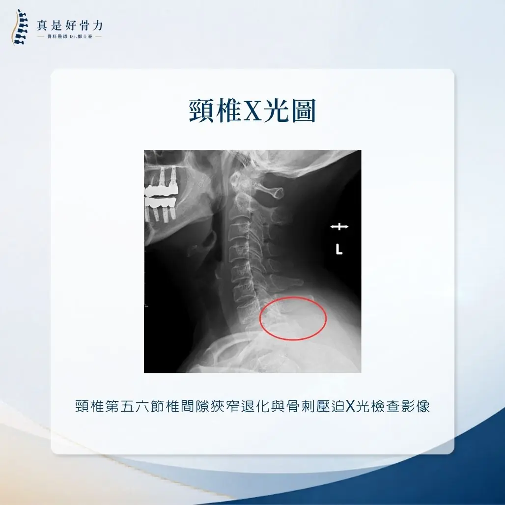 頸椎第五六節椎間隙狹窄退化與骨刺壓迫X光檢查影像